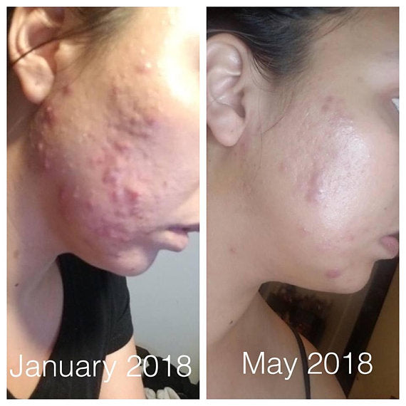 Butter Me Up™ Super Acne Fighter – Organic Acne Treatment Serum