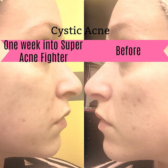 Butter Me Up™ Super Acne Fighter – Organic Acne Treatment Serum
